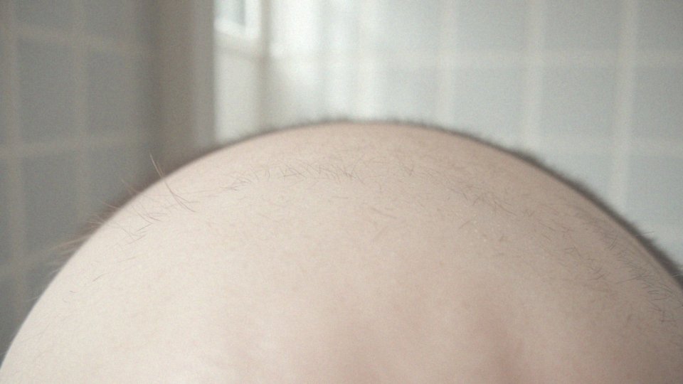 Jakie są oznaki uszkodzenia mieszków włosowych?