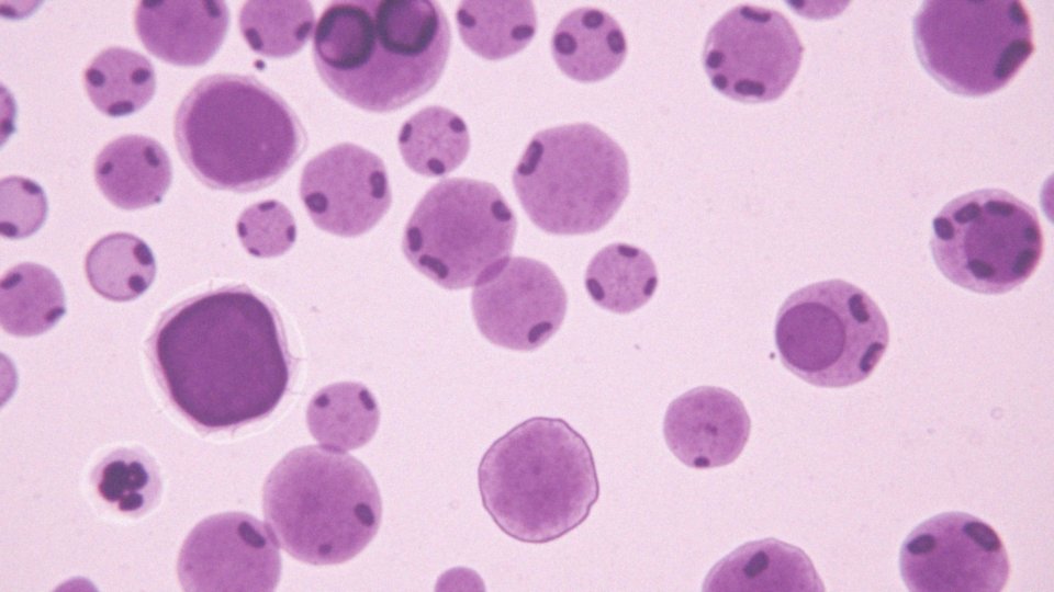 Jakie znaczenie mają leukocyty w diagnozowaniu białaczki?