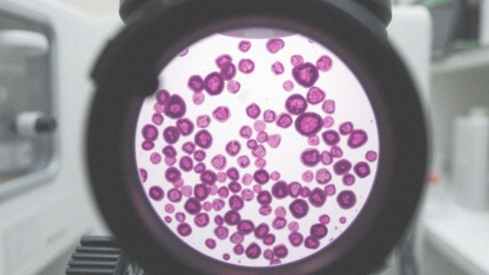 Jak w rozmazie krwi można zdiagnozować białaczkę?